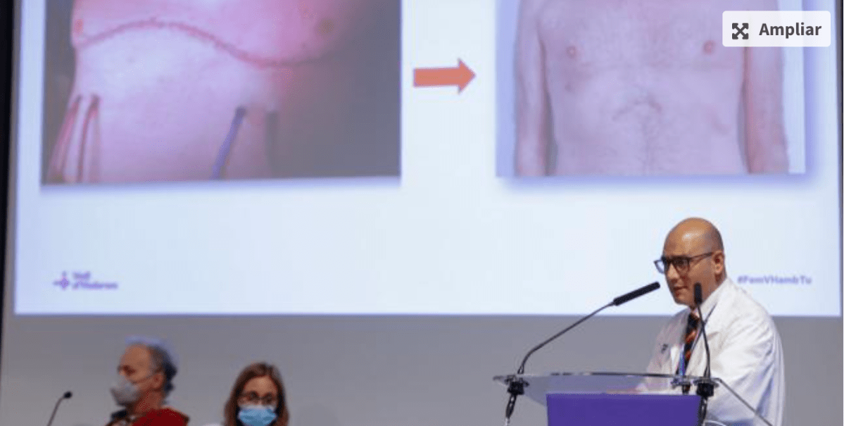 Minimally invasive robot-assisted lung transplant surgery (without opening the chest) carried out in Spain at the Val d’Hebron hospital, April 17, 2023